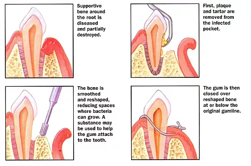 Flap Surgery